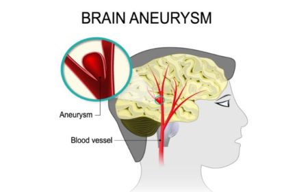 Recognising the Warning Signs: Key Symptoms of A Brain Aneurysm ...