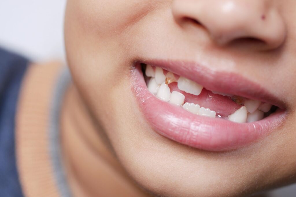 Mixed Dentition Checkups: The “In Between Teeth” Visits That Matter Most